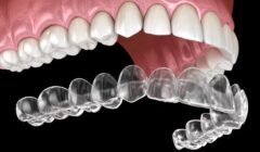 How Invisalign Aligners Adapt to Your Changing Lifestyle Demands