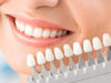 How Veneers Can Minimise Staining Risk and Resist Common Dietary Culprits