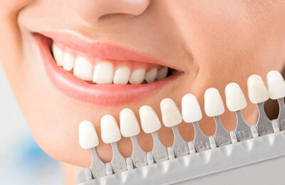 How Veneers Can Minimise Staining Risk and Resist Common Dietary Culprits