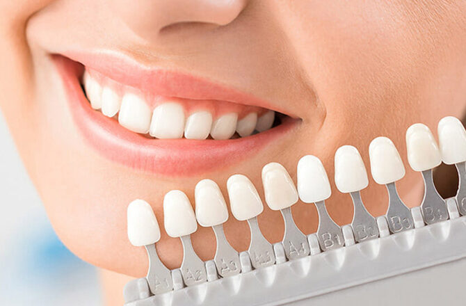 How Veneers Can Minimise Staining Risk and Resist Common Dietary Culprits