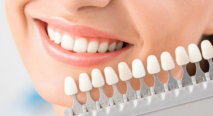 How Veneers Can Minimise Staining Risk and Resist Common Dietary Culprits
